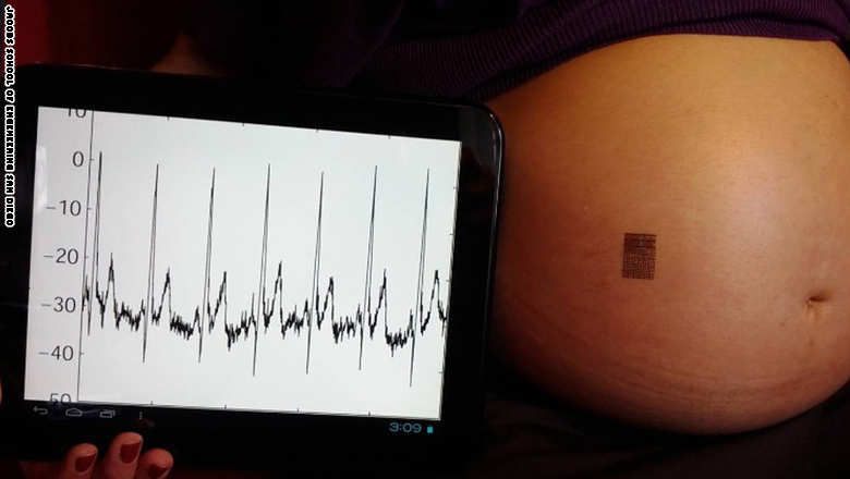 استخدمت جامعة سان دياغو ملصقة Biostamp التكنولوجية خلال دراستها للمرأة الحامل لمعرفة العلامات الحيوية للجنين. 