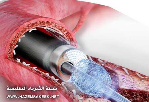 كيف تعمل قسطرة القلب Cardiac Catheterization