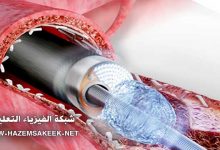 كيف يستخدام ليزر الاكسيمر في التخلص من انسداد الشرايين