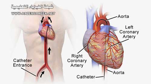 كيف تعمل قسطرة القلب Cardiac Catheterization
