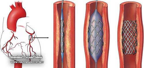 كيف تعمل قسطرة القلب Cardiac Catheterization