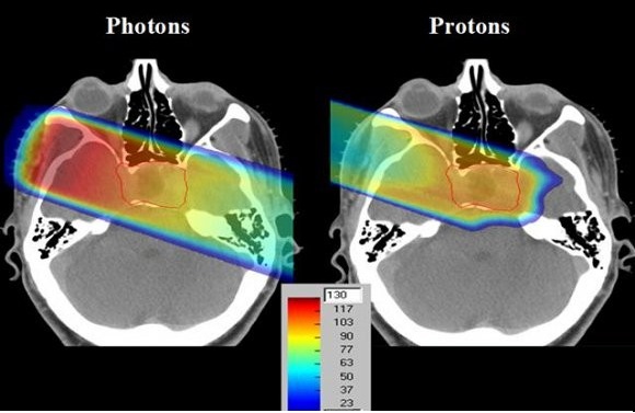 العلاج البروتوني Proton Therapy